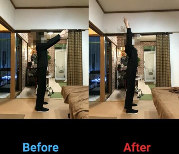 肩凝りがひどく頭痛がするのと、結婚式前に体の歪みを綺麗にできればと思いうかがいました。はじめに、現在どの程度体が歪んでいるのかを鏡を見ながら、人体骨格模型を使いながら丁寧に説明していただきました！猫背であることに自覚はあったので、正しい姿勢をとろうと努力した時もありましたが、全身に力を入れないと背筋を伸ばすことができず、長時間保てないので諦めていました。しかし、施術していただくと肩凝りが解消されたのは勿論、肩や腰の可動域が広くなり体がとても軽くなりました。施術前は前傾姿勢で頭が前に出てるような姿勢でしたが、正しい姿勢も自然にとることができるようになりました。また、骨盤が正しい位置に戻ったことにより、お尻もキュッと引き締まり小尻になりました！！！たった一回の施術でこんなにたくさんの効果を感じることができてとても感動です！！！次回も楽しみで仕方ありません！！！