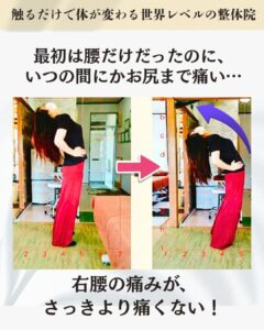 最初は腰だけだったのに、いつの間にかお尻まで痛いお客様のビフォーアフター