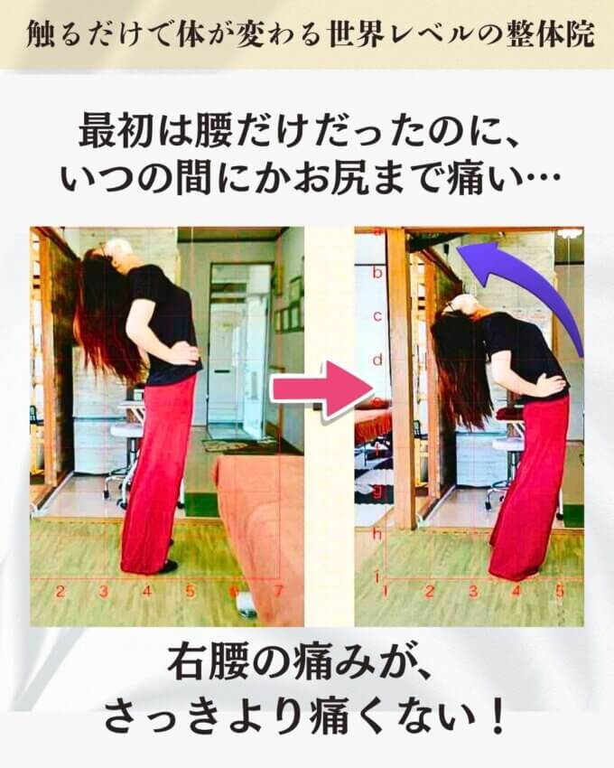 最初は腰だけだったのに、いつの間にかお尻まで痛いお客様のビフォーアフター